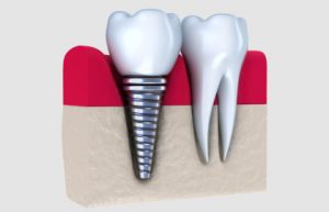 Smile Clinic-Allen Park, MI - Dental Implants