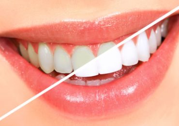 Smile Clinic-Allen Park, MI - GLO Teeth Whitening